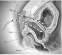 Surgical Experimentation by the 'Father of Gynaecology' on African American Slaves Surgical Experimentation by the 'Father of Gynaecology' on African American Slaves